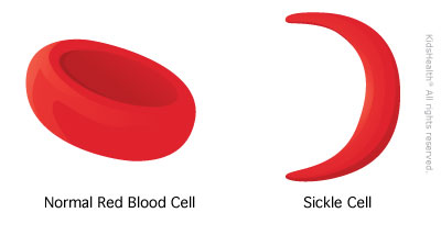 Sickle Cell Disease