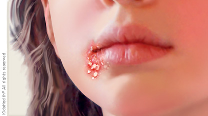Impetigo