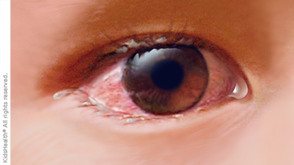 Pinkeye