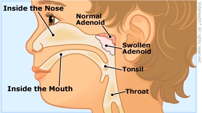 Adenoids and Adenoidectomies