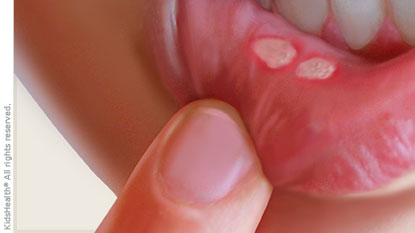 Canker Sores