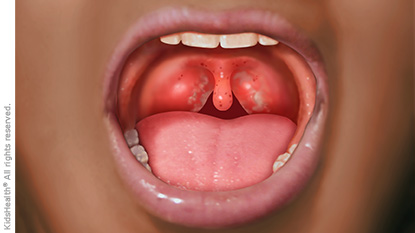 Tonsillitis
