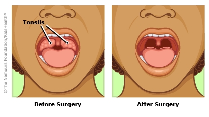 Having Your Tonsils Taken Out