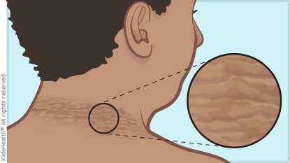 Acanthosis Nigricans