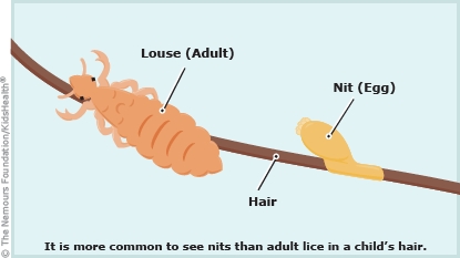 Head Lice