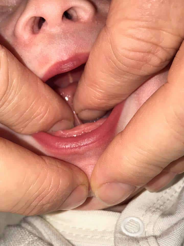 Does My Baby Have a Tongue Tie?