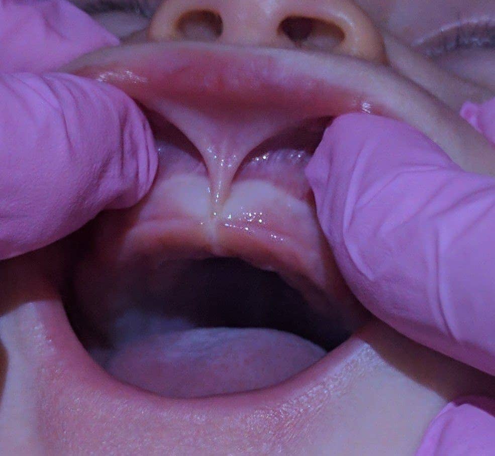 Does My Baby Have a Tongue Tie?