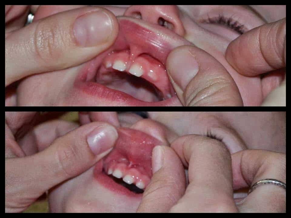 Does My Baby Have a Tongue Tie?