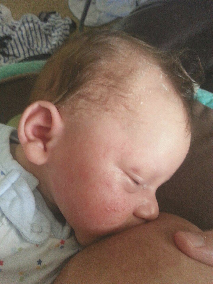Types of Baby Rashes