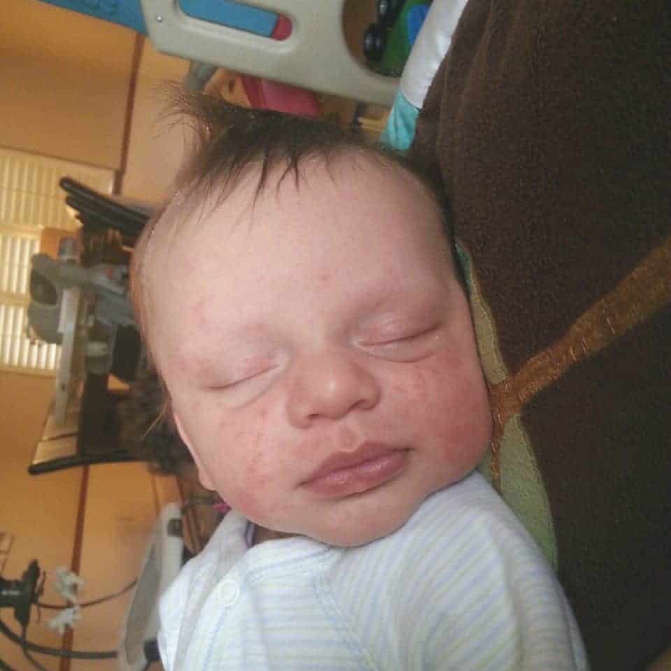 Types of Baby Rashes