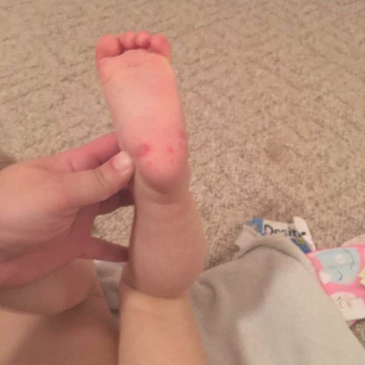 Types of Baby Rashes