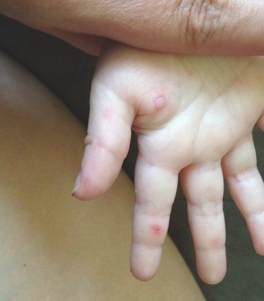 Types of Baby Rashes