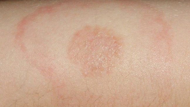 Types of Baby Rashes