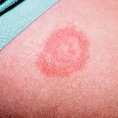 Types of Baby Rashes