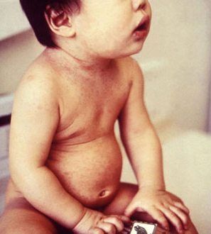 Types of Baby Rashes