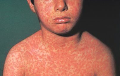 Types of Baby Rashes