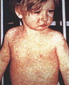 Types of Baby Rashes