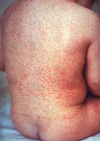 Types of Baby Rashes