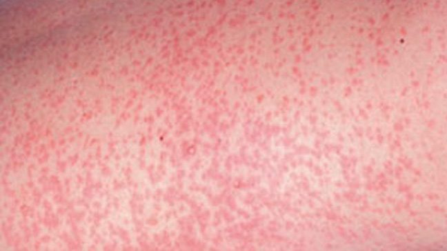 Types of Baby Rashes