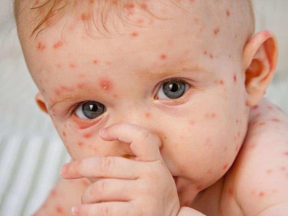 Types of Baby Rashes