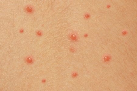 Types of Baby Rashes