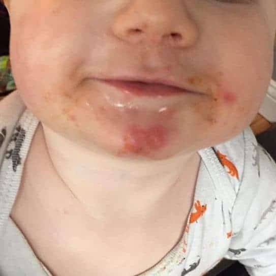Types of Baby Rashes