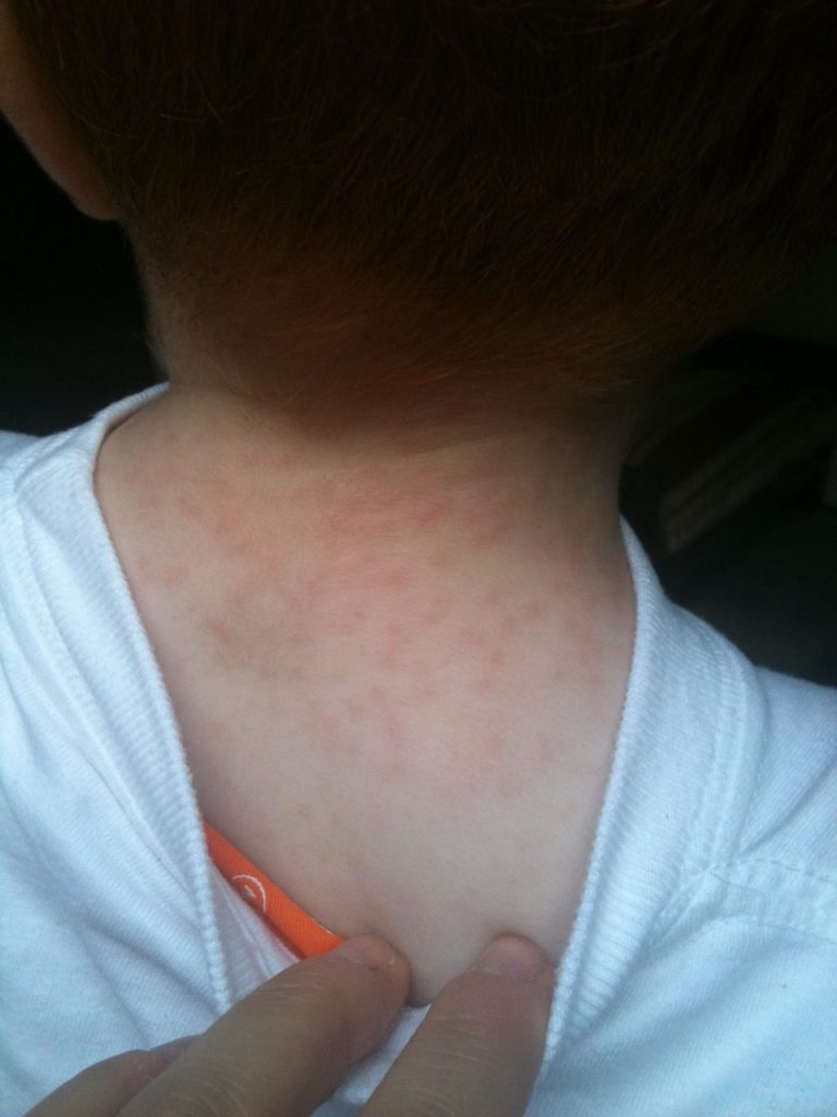 Types of Baby Rashes
