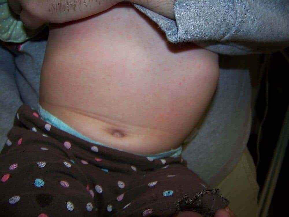 Types of Baby Rashes