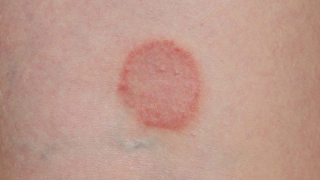 Types of Baby Rashes