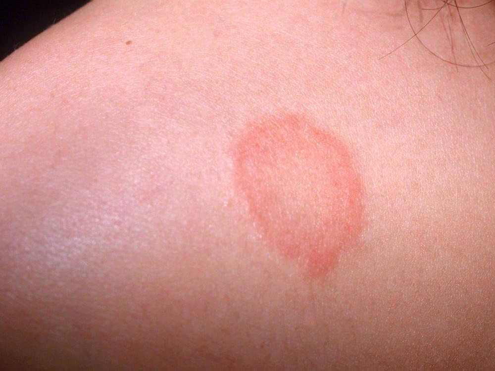 Types of Baby Rashes
