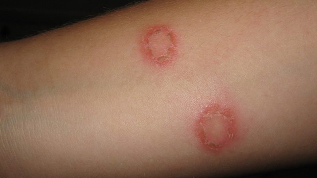 Types of Baby Rashes