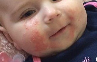 Types of Baby Rashes