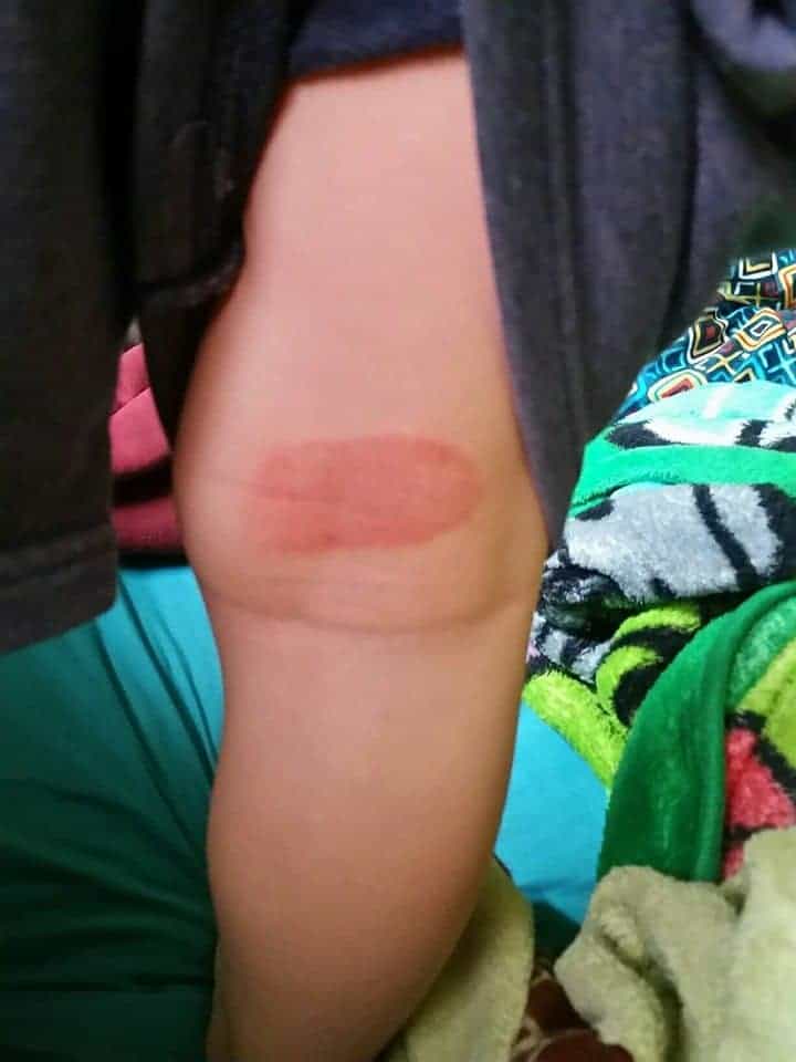 Types of Baby Rashes