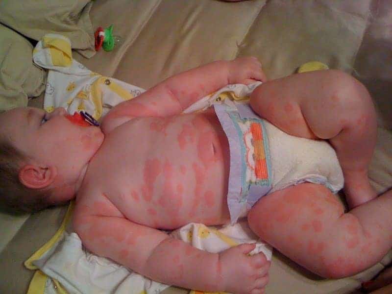 Types of Baby Rashes