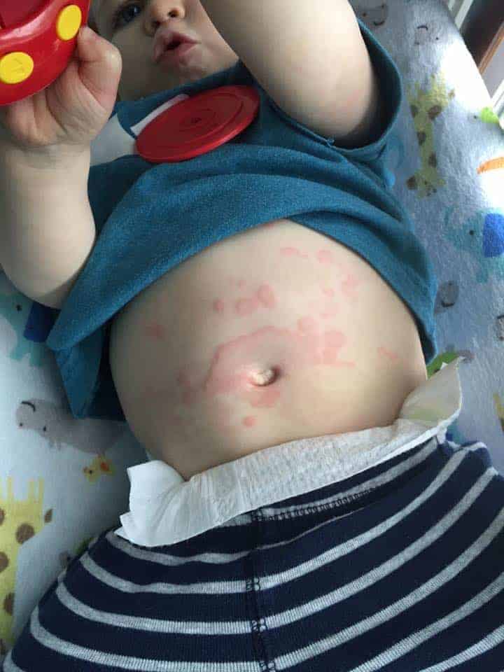 Types of Baby Rashes
