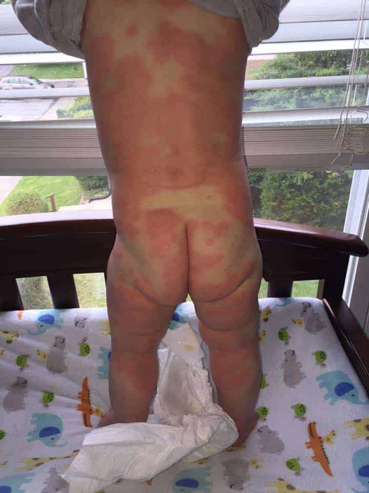 Types of Baby Rashes