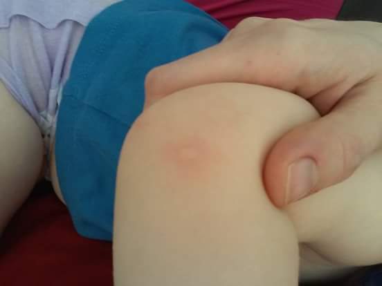 Types of Baby Rashes