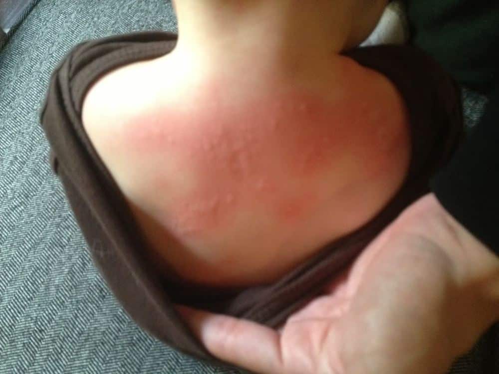 Types of Baby Rashes