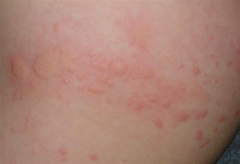 Types of Baby Rashes