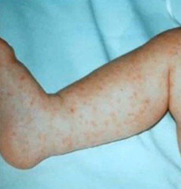 Types of Baby Rashes