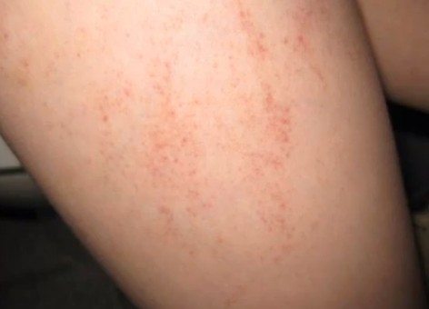Types of Baby Rashes