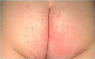 Types of Baby Rashes