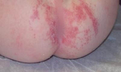Types of Baby Rashes