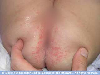 Types of Baby Rashes