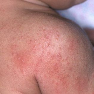 Types of Baby Rashes