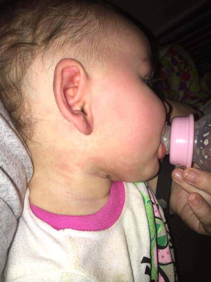 Types of Baby Rashes
