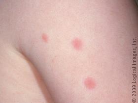 Types of Baby Rashes