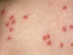 Types of Baby Rashes