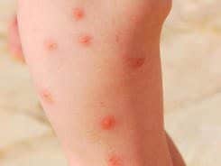 Types of Baby Rashes