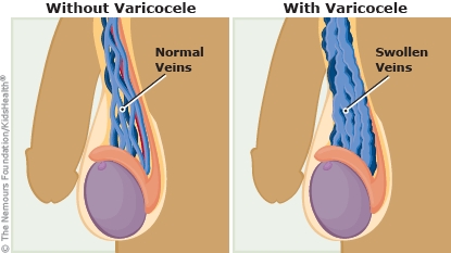 Varicocele